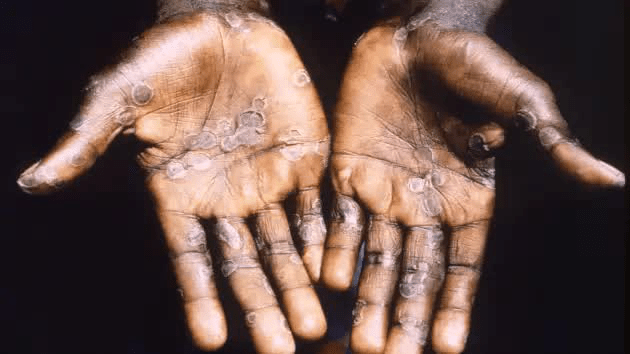 Decoding the global monkeypox epidemic: Is the next pandemic threatening humanity? - Photo 7.