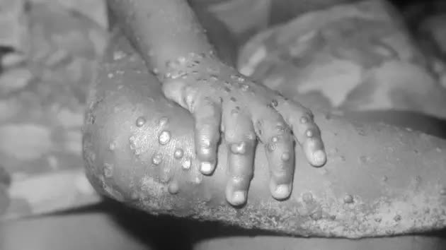 Decoding the global monkeypox epidemic: Is the next pandemic threatening humanity? - Photo 4.